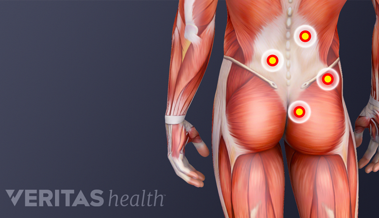 Ilustración de los músculos de la parte inferior de la espalda, glúteos, muslos y brazos, con 4 marcadores que muestran los puntos de activación.