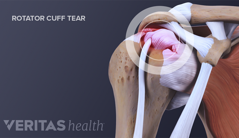 Illustration of shoulder joint anatomy showing rotator cuff tear.