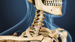 Anterior view of the cervical spine showing location of ACDF.