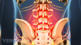 Espalda baja con el área de dolor causada por la enfermedad degenerativa del disco lumbar resaltada