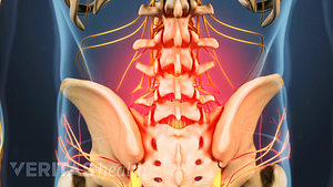 Espalda baja con el área de dolor causada por la enfermedad degenerativa del disco lumbar resaltada