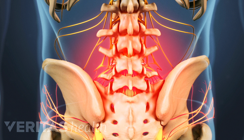 Illustration showing lower back pain highlighted in red.