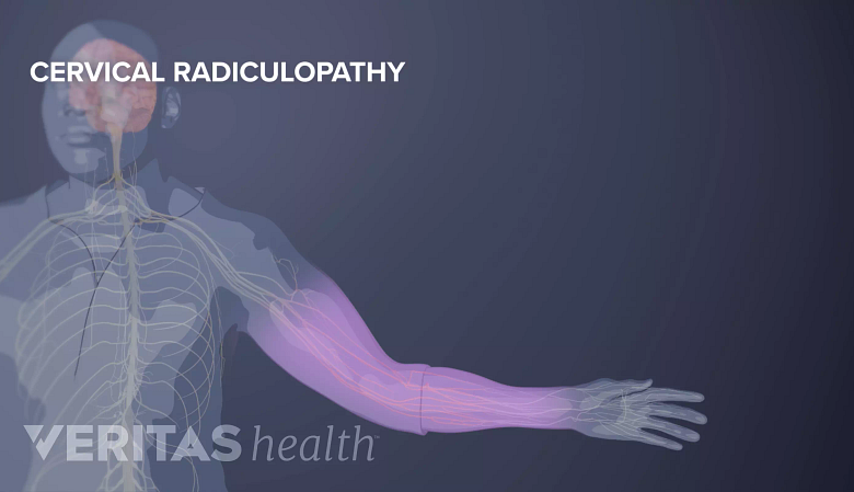 An illustration showing cervical radiculopathy.