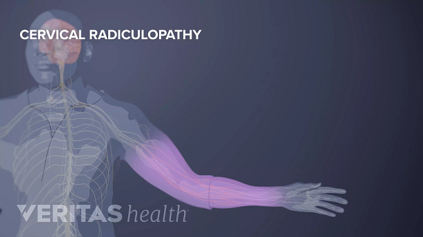 An illustration showing cervical radiculopathy.