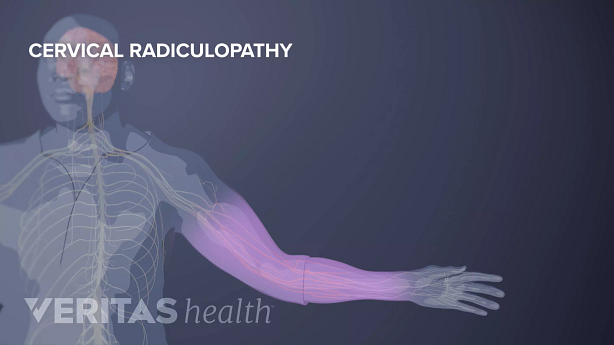 Un resonancia magnética que destaca la radiculopatía cervical.