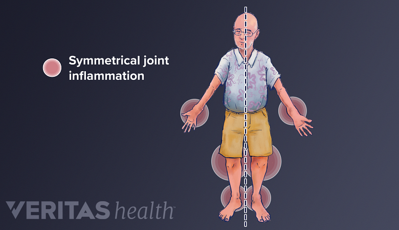 Illustration of symmetrical joint pain from rheumatoid arthritis