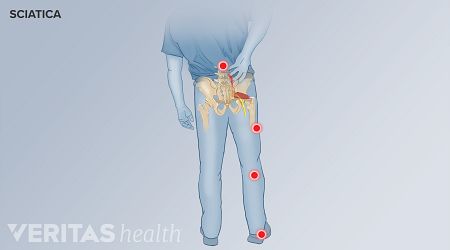 Illustration showing the pattern of pain distribution of sciatica in the lower back and leg. 
