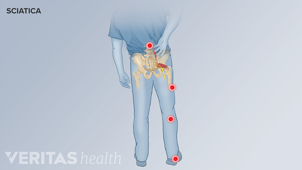 Pain pattern of sciatica in the lower back and leg.