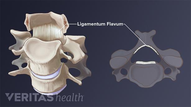 Anterior and superior views of a vertebra showing the ligamentum flavum running parallel to the spinal cord.