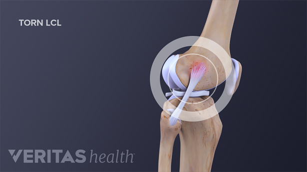 A torn lateral collateral ligament (LCL)