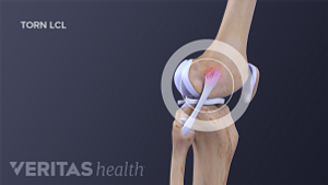 Profile view of the knee joint to show LCL.