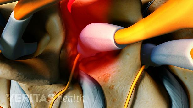 Medical illustration of nerve impingement in the cervical spine