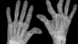 X-ray of hands with rheumatoid arthritis