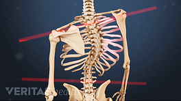 Bracing Options for Scoliosis