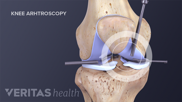 Medical illustration of knee arthroscopy for arthritis