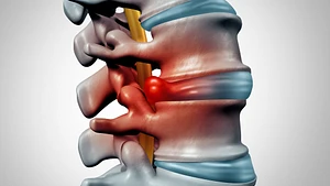 Characteristics and mechanisms of resorption in lumbar disc herniation, Arthritis Research & Therapy