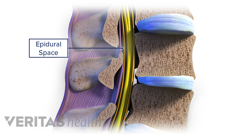 Illustration showing saggital section of the spine showing epidural space.