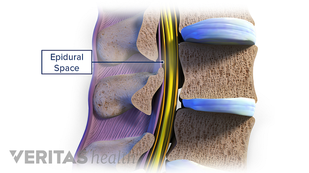An illustration showing epidural space in the lower back.
