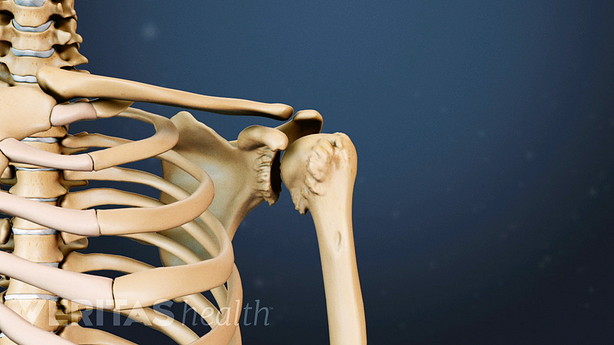 Shoulder ArthritisMedical illustration showing goats bear osteophytes in the shoulder joint