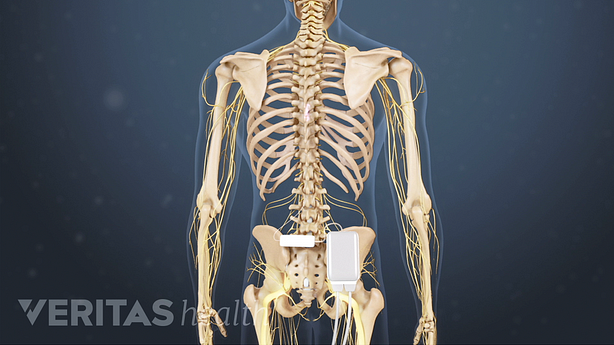 Spinal cord stimulator unit and leads in the spine.