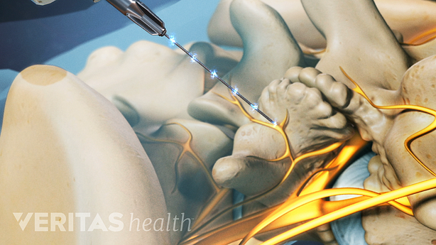 Radiofrequency Ablation (RFA): Procedure and Recovery | Spine-health