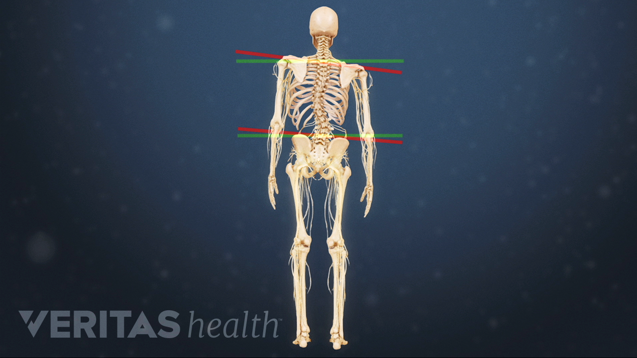 All About Degenerative Scoliosis | Spine-health