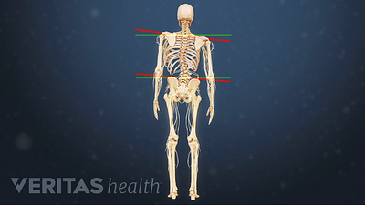 Posterior view of a spine with degenerative scoliosis curve