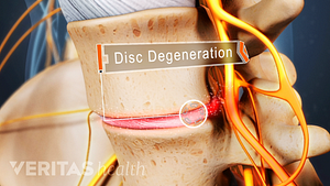 Disc degeneration in the lumbar spine