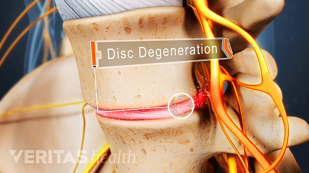 Profile view of lumbar spine showing disc degneration.