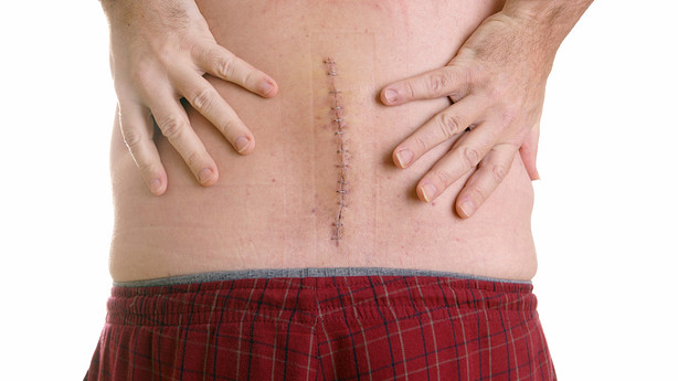 A 4-6 inch suture on a person's lower back.
