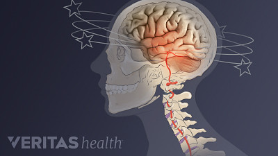 Profile of neck pain causing dizziness