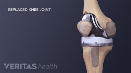 Medical illustration of a completed knee replacement surgery