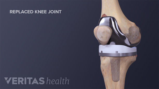 Medical illustration of a completed knee replacement