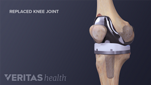 Medical illustration of a replaced knee joint