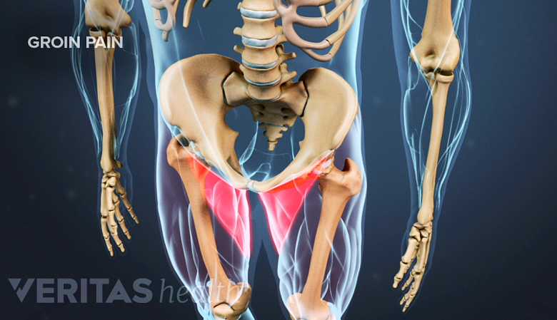 Anatomy of hip showing red highlights in the groin region.
