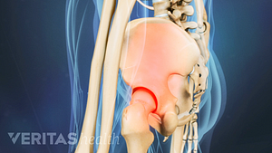 Profile view of the hip showing pain in the SI Joint.