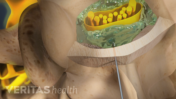 An illustration showing needle inserted in the epidural space.