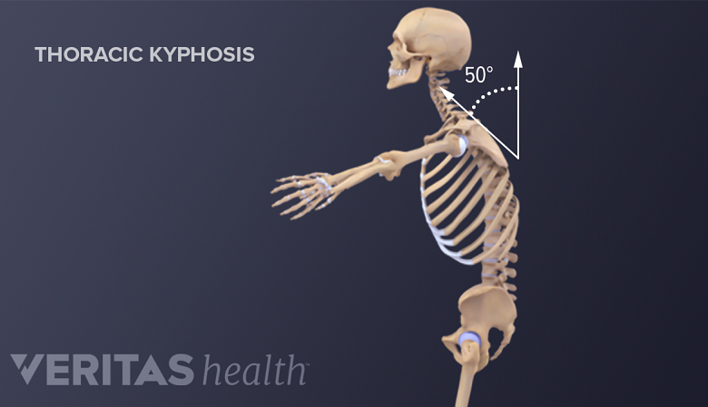 Illustration showing lateral view of a skeleton with kyphosis.