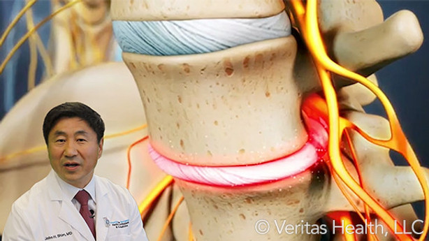 Profile view of degenerative disc disease in the lumbar spine with Dr. Shim