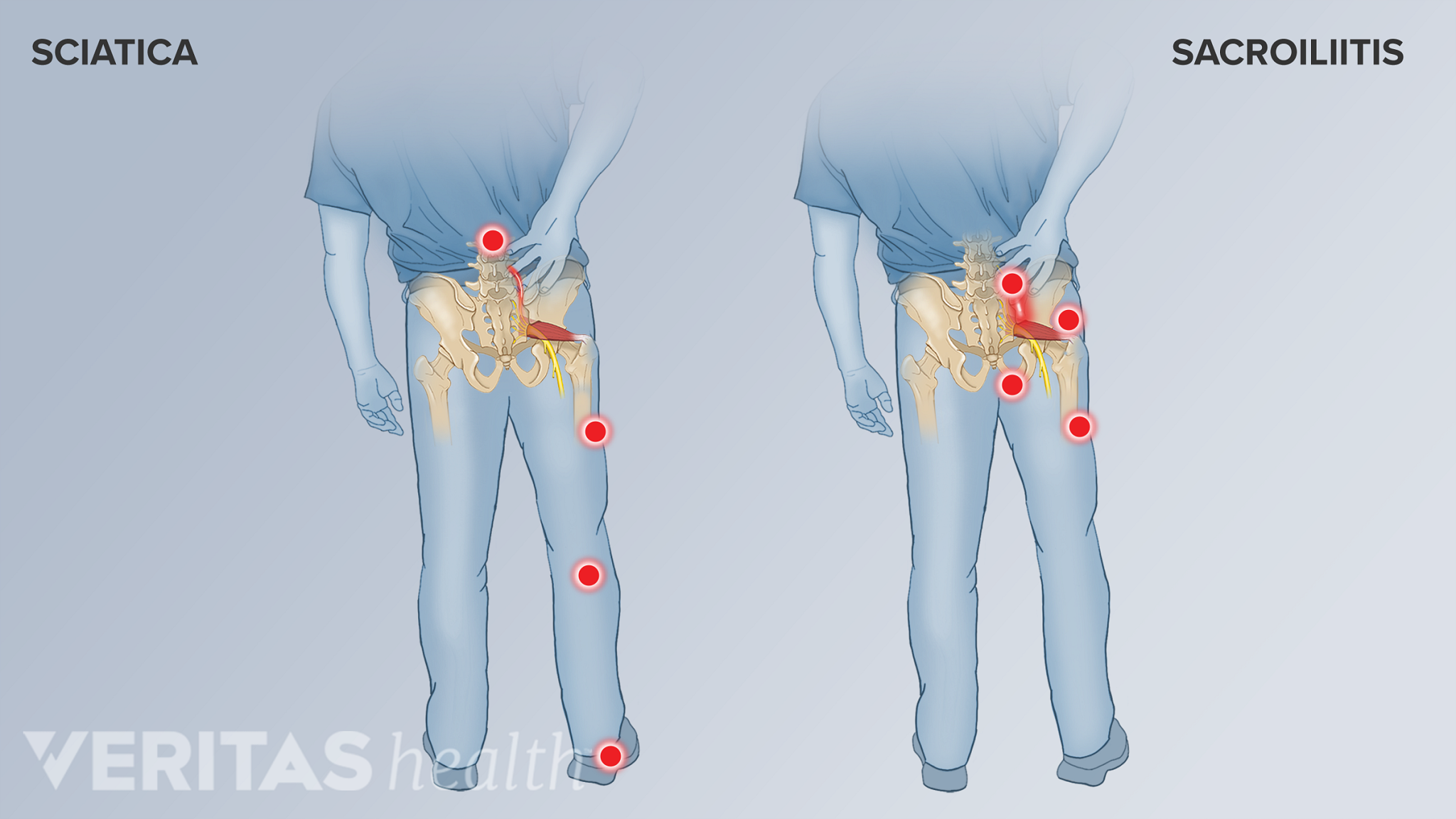 Symptoms And Diagnosis Of Sacroiliitis | Spine-health