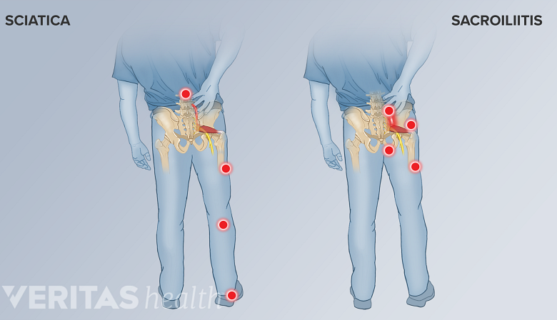 2 Illustrations of a man holding his lower back. Red dots indicate pain areas. Left to right. Sciatica and SI joint pain.