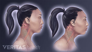 Illustration of the effect of forward head posture on the neck muscles