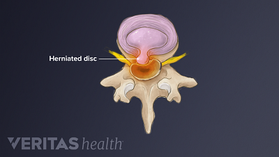 Medical illustration of the lumbar vertebrae labeling the herniated disc.
