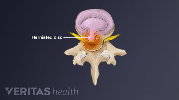 Illustration showing lumbar herniated disc.