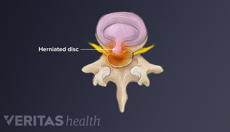 A herniated disc in the lumbar spine.