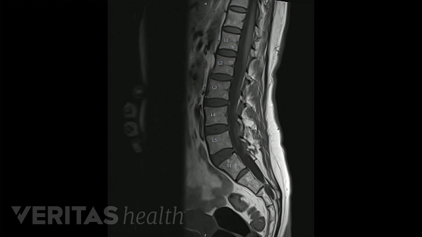 Illustration showing MRI scan of lumbar spine.