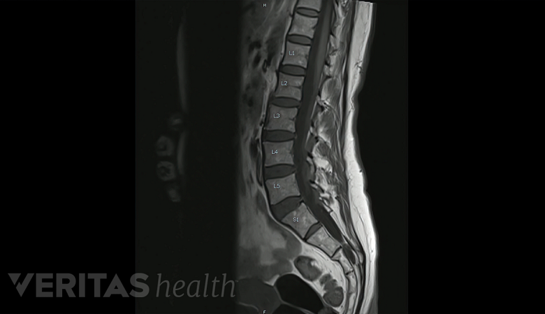 Illustration showing MRI scan of upper and lower spine.
